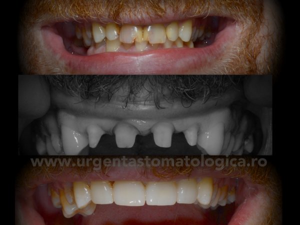 Coroane dentare ceramică – Cabinet stomatologic Drumul Taberei Sector București